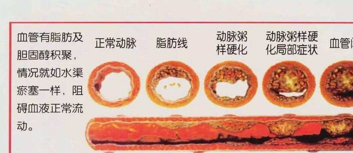 近年脑血管疾病发病率上升趋势及观点论述