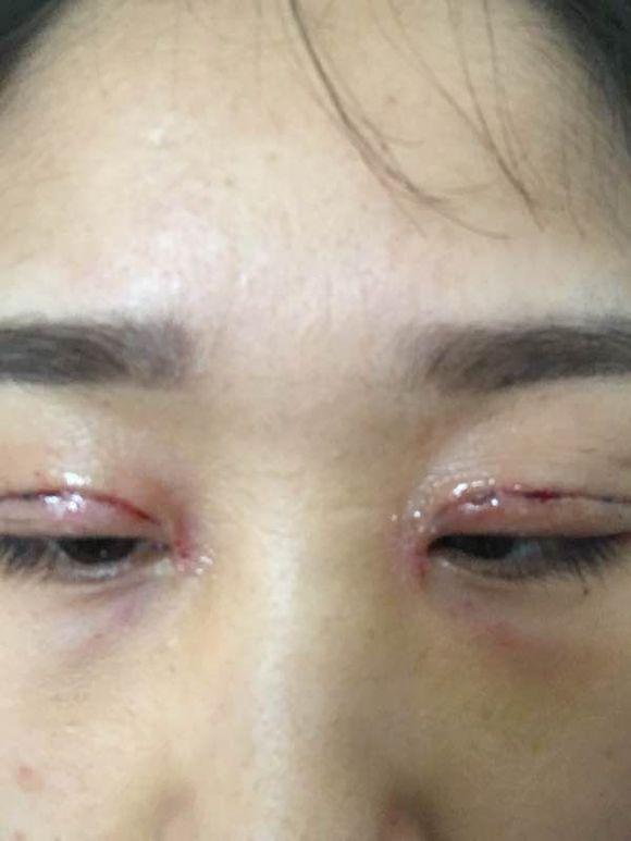 警惕日常细节中的健康隐患，拆快递后揉眼引发眼部带状疱疹病例提醒