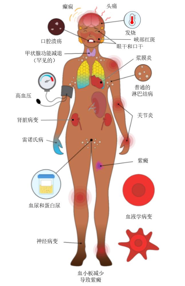 红斑狼疮最新消息详解，全面指南与应对步骤