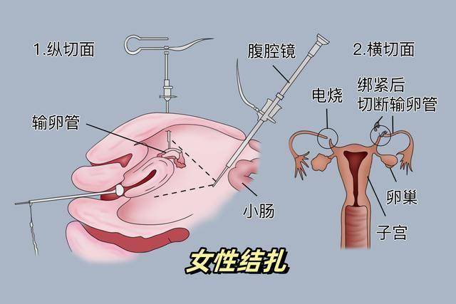 女性最新节育方法，小丽的体验之旅与友情探索